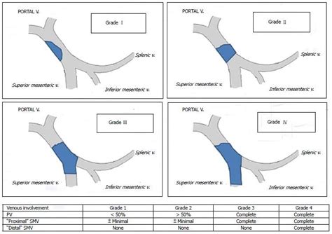 Portal vein thrombosis classification according to Yerdel et al[3]. PV ...