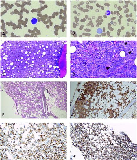 Ab Peripheral Blood Smear A Acute Megakaryoblastic Leukemia