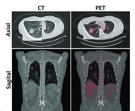 CT And PET CT Showing The Pulmonary Nodule Growth Verified In August