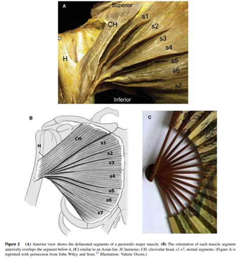 Pectoralis Major Rupture Dr Wael Bayoud