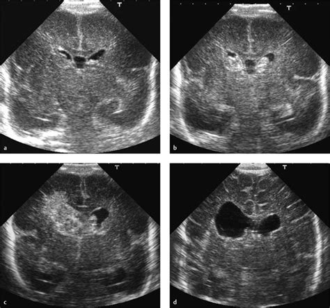 3 Neonatal Cranial Ultrasonography Radiology Key