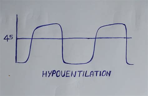 Capnography Waveform Interpretation