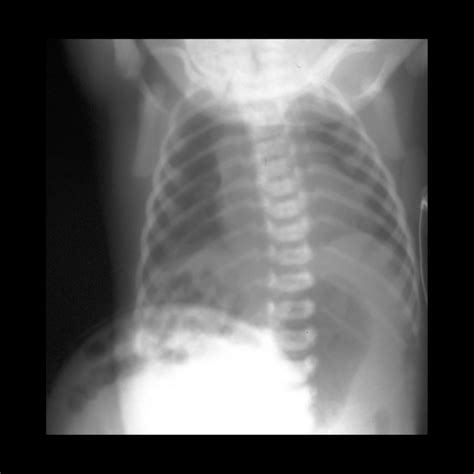 Newborn With An Anterior Abdominal Wall Defect On Prenatal Us