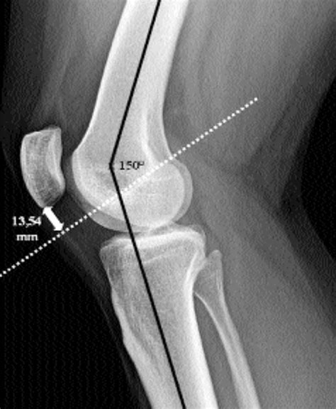 Patellar Dislocation Introduction And Diagnosis Sports Medicine Review