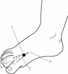 Post Traumatic Stimulus Suppressible Myoclonus Of Peripheral Origin