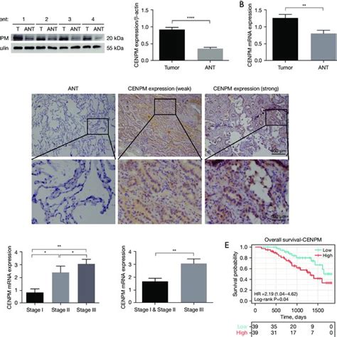 Upregulation Of Cenpm In Luad Patients Correlates With Higher