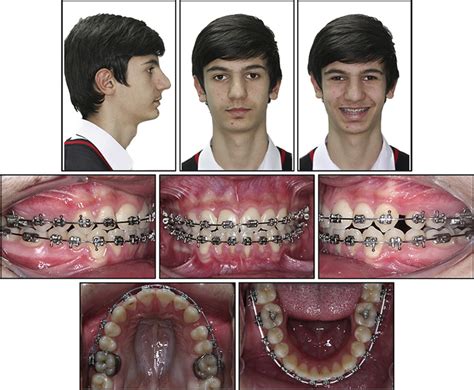 Combined Orthodontic Orthopedic Treatment Of An Adolescent Class Ii