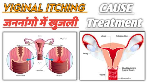 VIGINAL ITCHING जननग म खजल INFECTION IN VIGINA