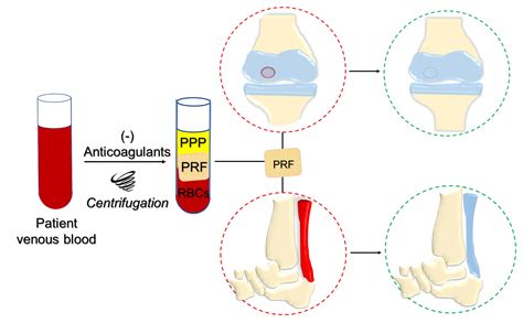 Ijms Free Full Text Platelet Rich Fibrin Scaffolds For Cartilage