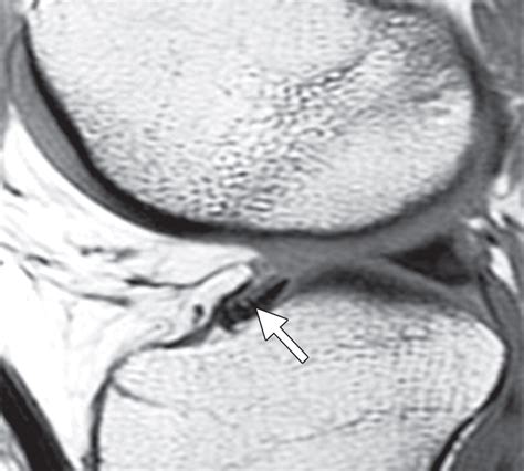 Mr Imagingbased Diagnosis And Classification Of Meniscal Tears