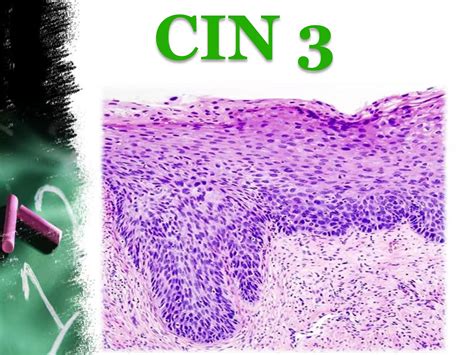 Cervical Intraepithelial Neoplasia Ppt