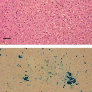 Biochemical measurement of liver iron (LIC-liver iron content, measured ...