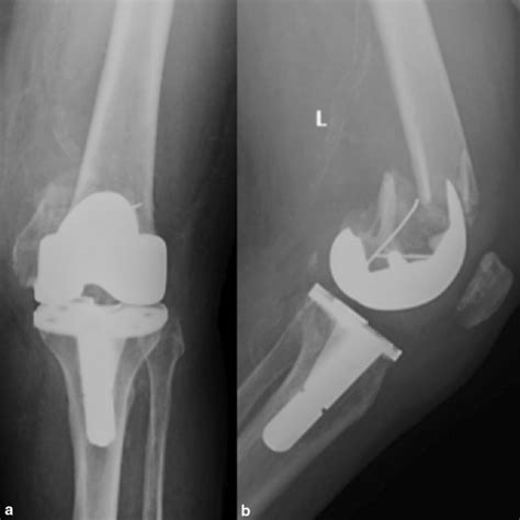 X Ray Images Showing A Distal Femoral Periprosthetic Fracture A Download Scientific Diagram