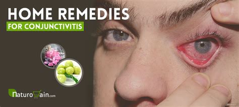 9 Best Home Remedies for Conjunctivitis to Prevent Pink Eyes [Naturally]