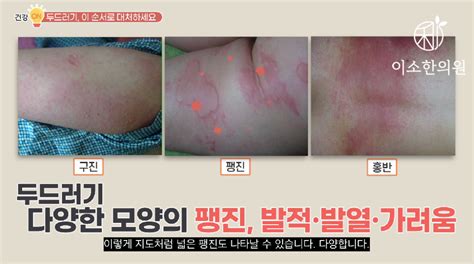 두드러기 졸레어 주사 맞으면 완치만성 두드러기 치료 관리법 총정리 이소한의원