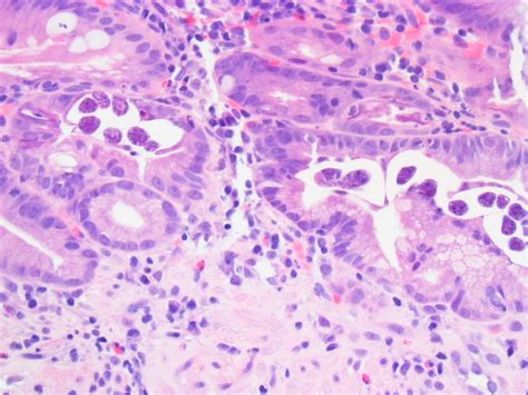 Intestinal Strongyloides Strongyloidiasis