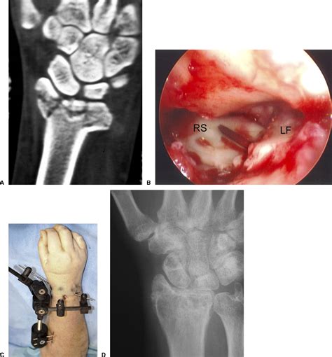 Wrist Arthroscopy Current Concepts Journal Of Hand Surgery