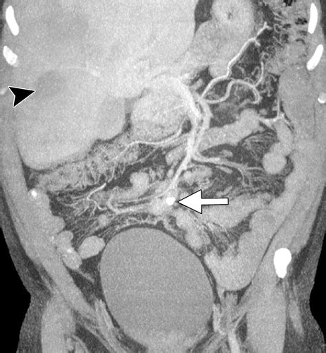 Midgut Neuroendocrine Tumors Imaging Assessment For Surgical Resection Radiographics