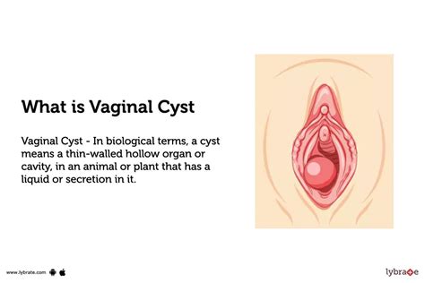 Vaginal Cyst