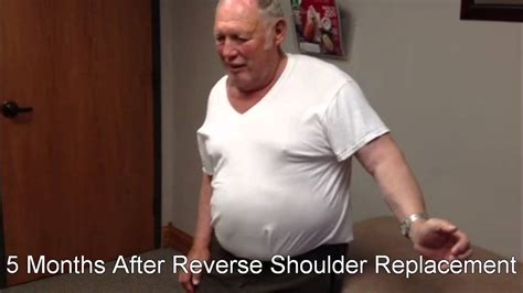 Reverse Total Shoulder Replacement Before After, 55% OFF