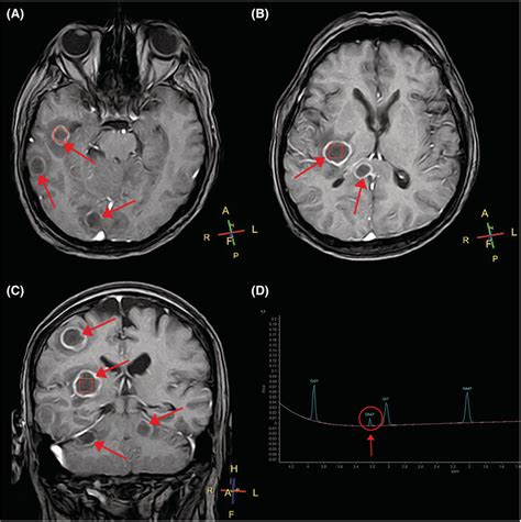 Contrast Mri And Spectroscopy A B Contrast‐enhanced Brain Mri T1