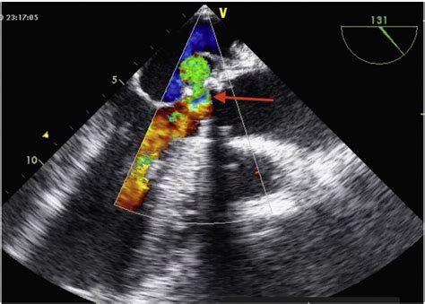 Pseudoaneurysm Of The Mitralaortic Intervalvular Fibrosa And Its