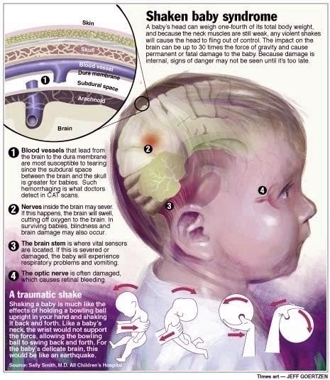 CoratCoret Nina Shaken Baby Syndrom SBS