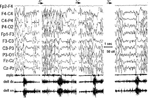 Ictal Eeg Recording Of Four Consecutive Periodic Spasms In Patient One