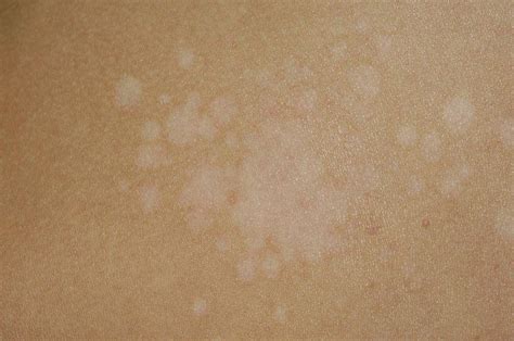 Pityriasis Versicolor Of The Skin Photograph By Dr P Marazzi Science