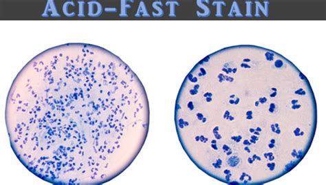 Ziehl Neelsen Staining