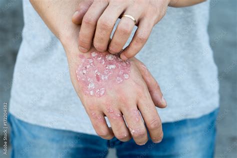 Man Scratch Oneself Dry Flaky Skin On Hand With Psoriasis Vulgaris