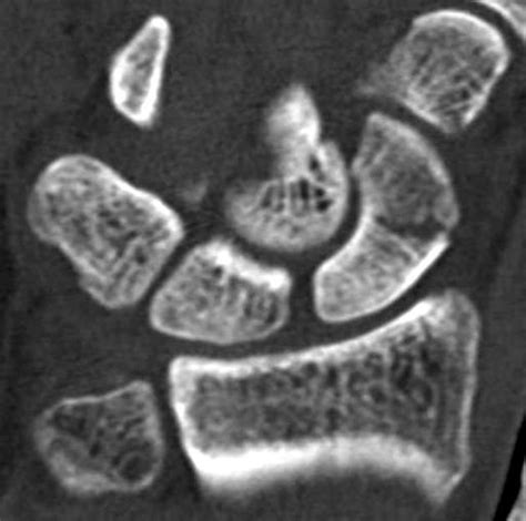 Scaphoid Fracture Avascular Necrosis