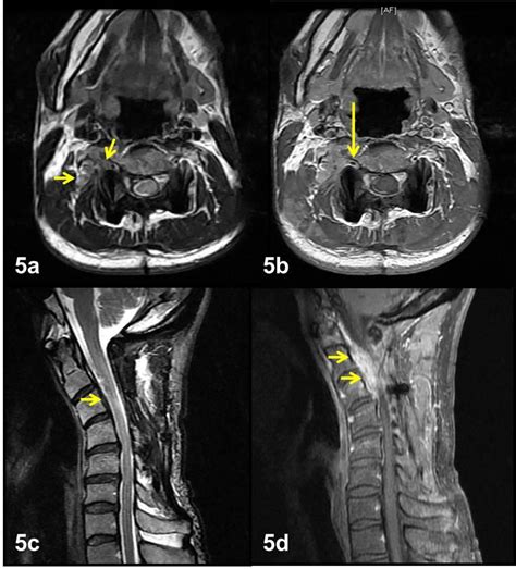 Figure From Extradural Cervical Spinal Meningioma Mimicking