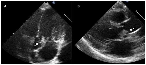 Jcm Free Full Text Pediatric Infective Endocarditis A Literature