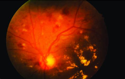 Severe Nonproliferative Diabetic Retinopathy. | Download Scientific Diagram