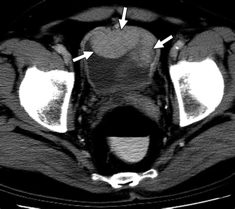 Transitional Cell Carcinoma Ultrasound