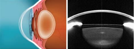 Posterior Chamber Phakic Intraocular Lens: Indications ...