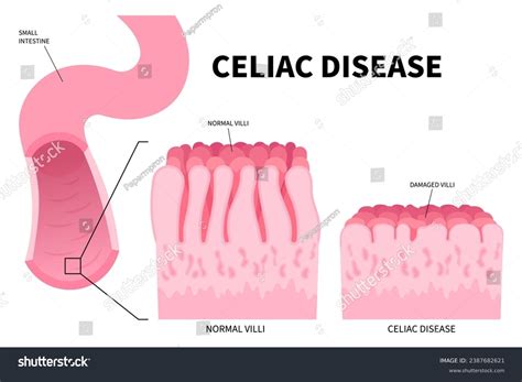 Small Intestinal Celiac Disease Stomach Bacterial Stock Vector Royalty Free 2387682621