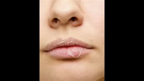 Chapped Lips 👄 Dry Lips Homemade Remady 💯 Shortsvideohomemade