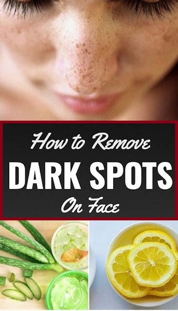 Dark Spots: Causes, Types, And Natural Treatment - Healthy Lifestyle