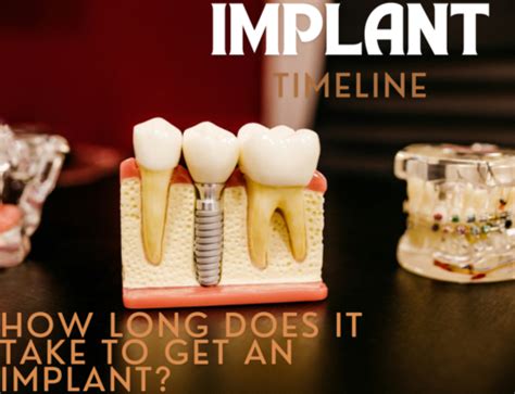 What Is A Dental Implant Mid State Oral Surgery And Implant Center