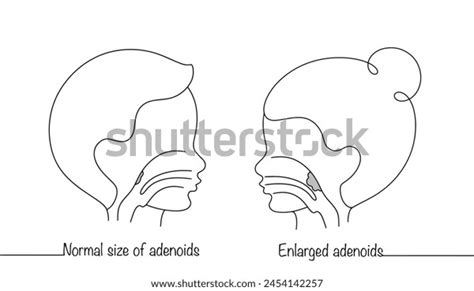 Boy Girl Adenoids Normal Enlarged Adenoids Stock Vector Royalty Free