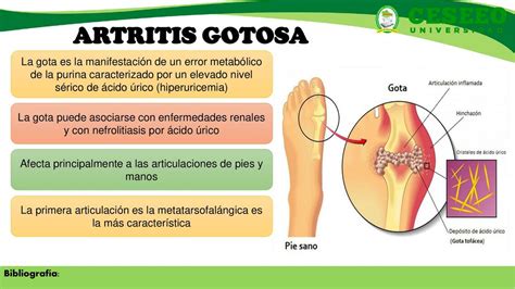 Artritis Gotosa Leslie Trinidad Avendaño uDocz