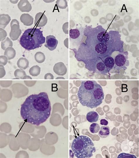 DUTCHER VERSUS RUSSELL BODIES IN PLASMA CELLS