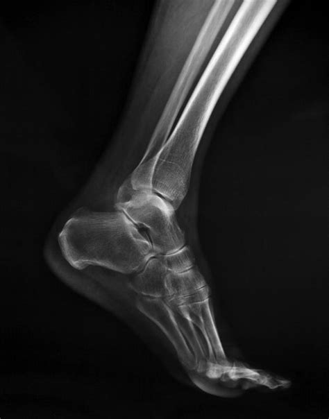 What Is a Lisfranc Fracture? (with pictures)