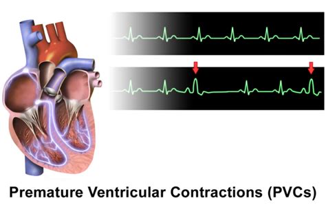 Why a PVC Can Cause Coughing » Scary Symptoms