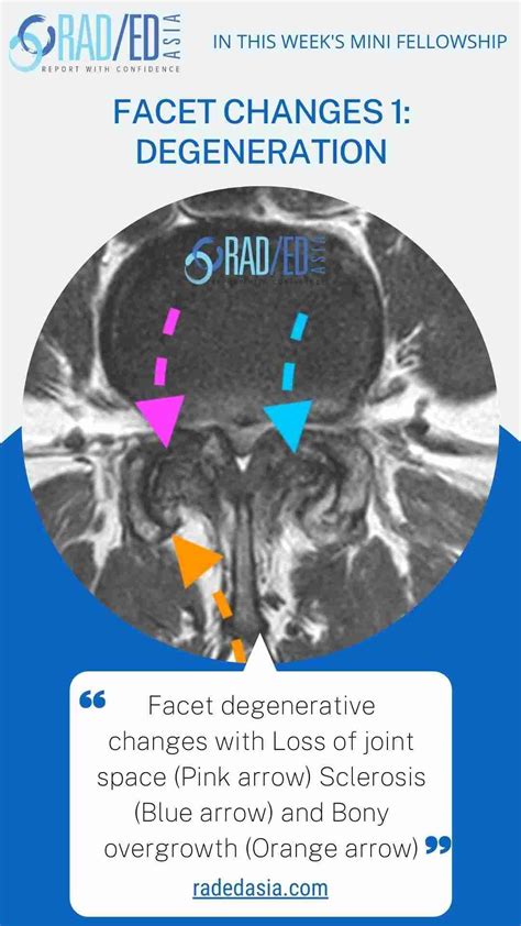 SPINE FACET JOINT MRI ONLINE RADIOLOGY COURSES: KEY POINTS FROM OUR SPINE MRI COURSES - Radedasia