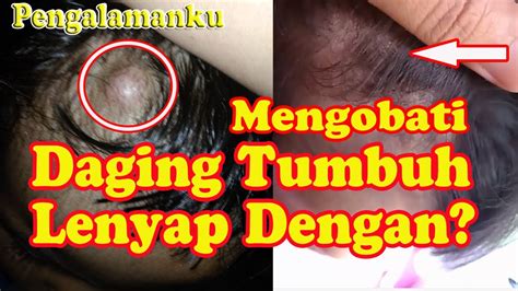 Cara Mengobati Daging Tumbuh Atau Uci Uci Atau Lipoma Tanpa Operasi