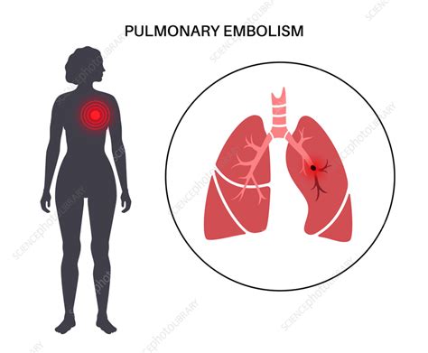 Pulmonary Embolism Illustration Stock Image F036 6472 Science Photo Library