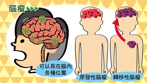 【癌症】頭痛持續亂說話腦瘤10大徵狀 或因5類癌症轉移到腦引致｜醫師easy